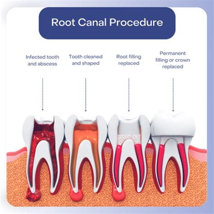 Comprehensive Guide to Upper Molar Root Canal: Everything You Need to Know