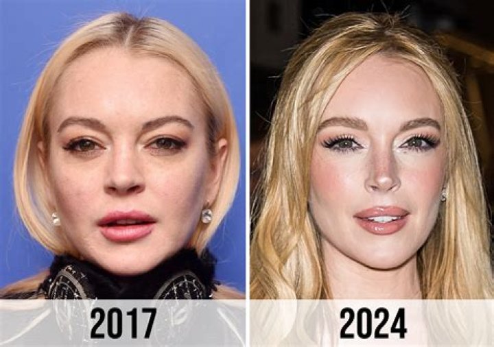 Lindsay Lohan's Plastic Surgery Journey: Unveiling Truths And Reflections