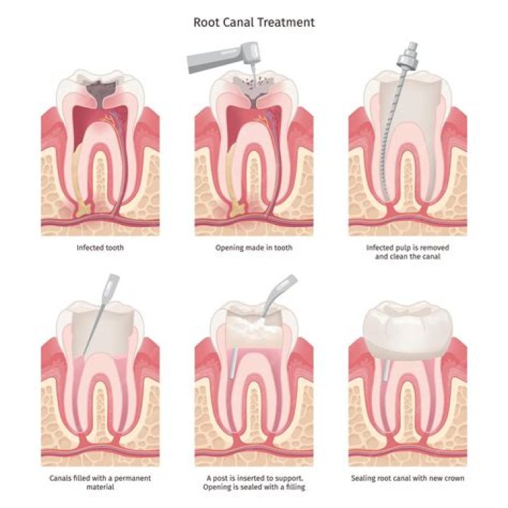 RCT Upper Molar: Comprehensive Guide to Root Canal Treatment for Upper Molars