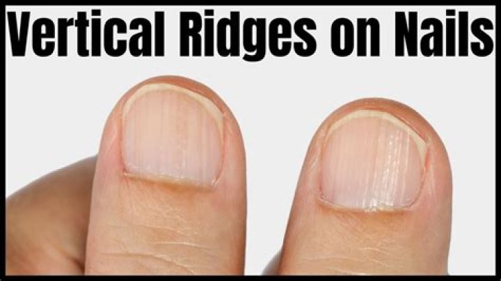 Understanding and Addressing Vertical Ridges on Nails
