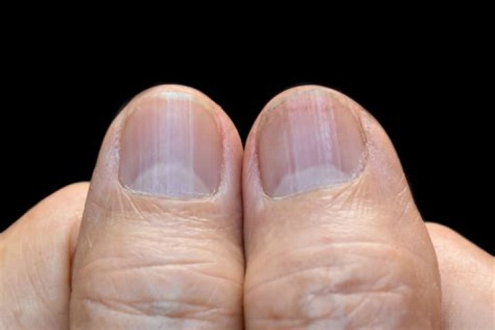 Understanding Fingernail Ridges and Their Connection to Vitamin Deficiencies