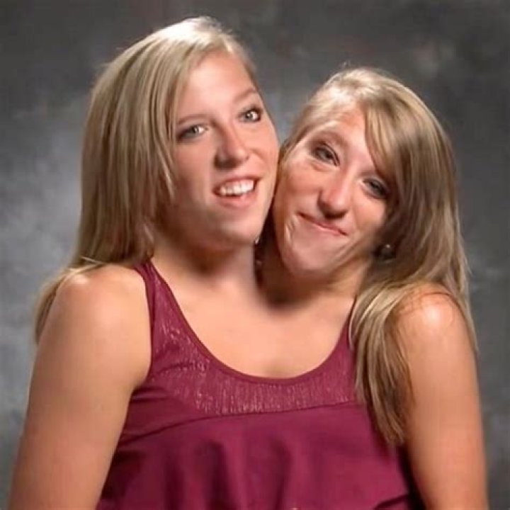 Understanding the Lives and Legacy of Abby and Brittany Hensel: Conjoined Twins and Their Journey